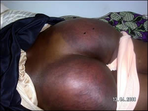 Reprisal attacks against voters in Zimbabwe