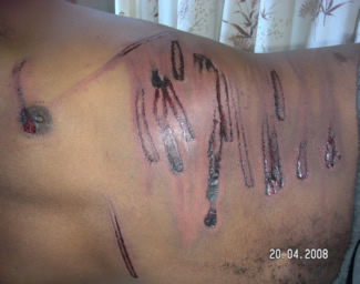 Man's torso with wounds from chains and fan belts