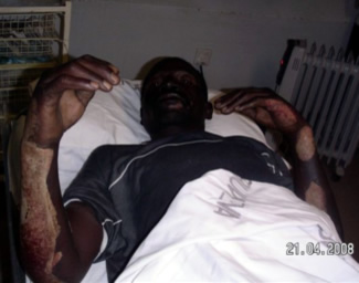 Man with burns after being set alight by pro-Zanu(PF) militia