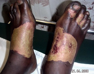 Man with burns after being set alight by pro-Zanu(PF) militia - feet