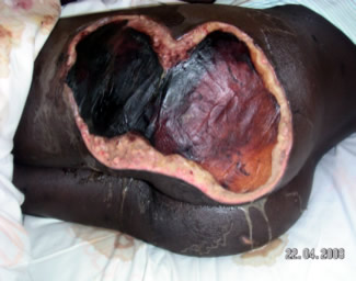 Severe buttock wound exacerbated by withholding medical treatment after beating