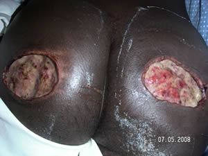 Severe buttock wound exacerbated by withholding medical treatment after beating