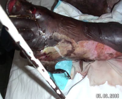 Burnt foot