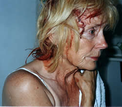 Birgit Kidd after being assaulted with rocks