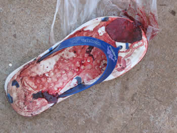 Slipper of blood
